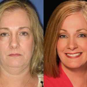 Real-Life Results: SMAS Facelift Before and After Guide