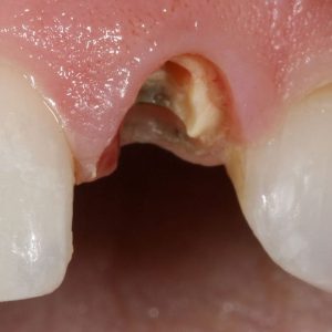 Efficient Guide: How To Pull A Broken Tooth At Home